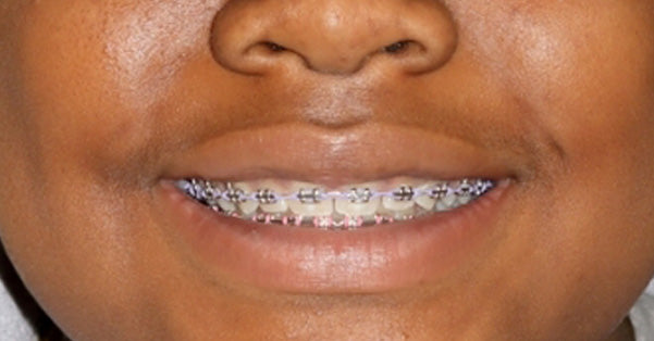 Metal Braces