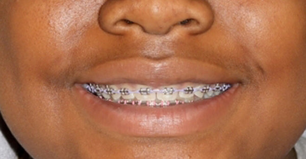 Metal Braces – Crawford and Wright Orthodontics