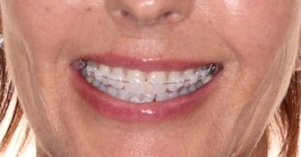 Metal Braces – Crawford and Wright Orthodontics